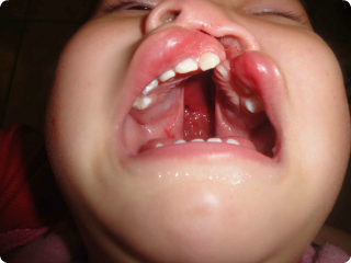 Veronica's cleft palate before the surgery.